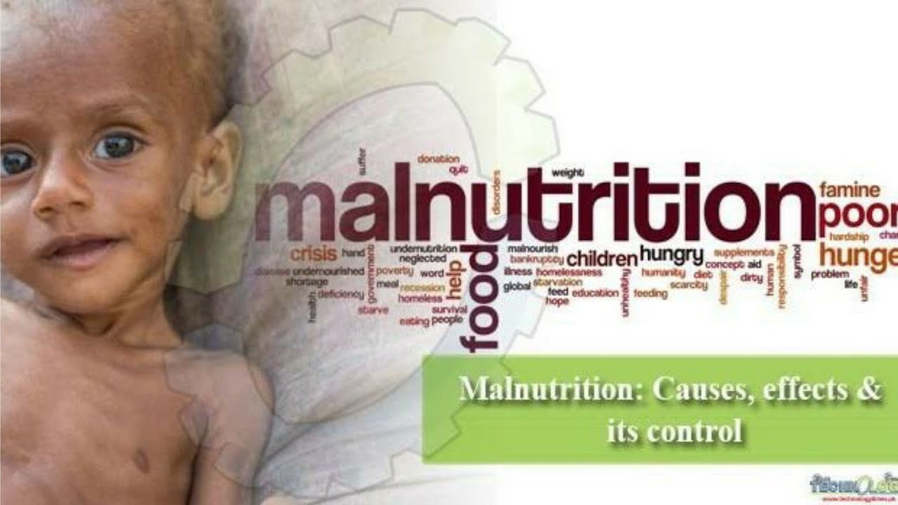 WHO: South Sudan’s Silent Killer—Acute Malnutrition WHO: South Sudan’s Silent Killer—Acute Malnutrition